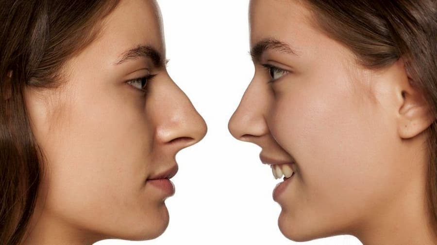 best rhinoplasty surgeons