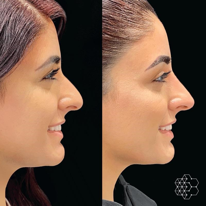 rhinoplasty expert nyc