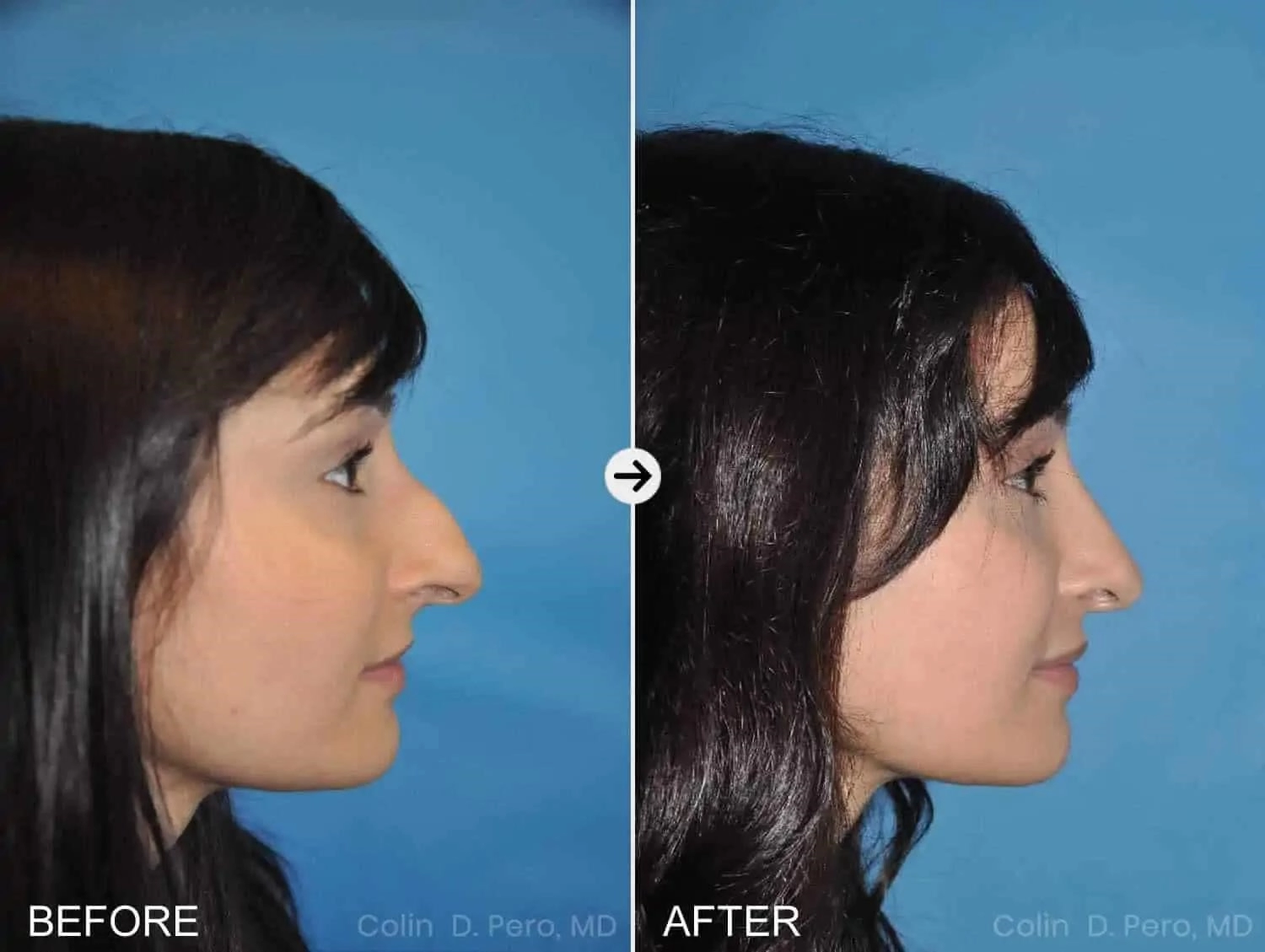 rhinoplasty expert nyc