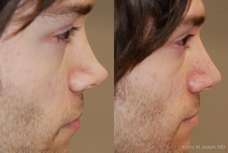 rhinoplasty expert nyc