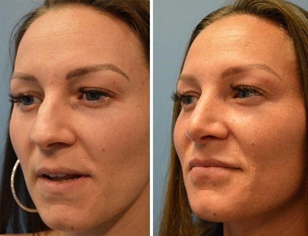 what is a closed rhinoplasty